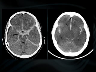 common pathologies of brain.pptx