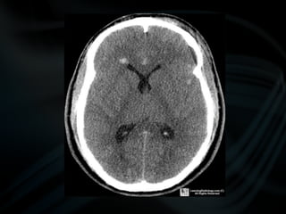 common pathologies of brain.pptx