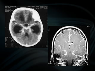 common pathologies of brain.pptx