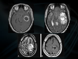 common pathologies of brain.pptx