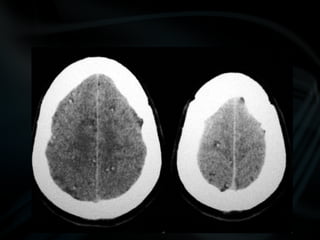 common pathologies of brain.pptx