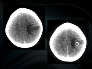 common pathologies of brain.pptx