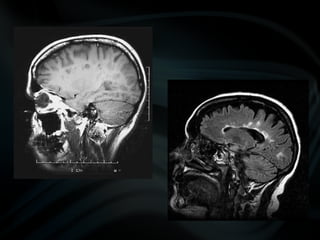 common pathologies of brain.pptx