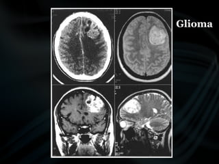 common pathologies of brain.pptx