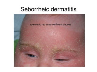 Confluent Rash Patch Common Pediatrics Rashes.ppt well explained pictutes | PPT