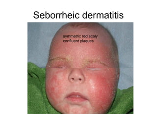 Common Pediatrics Rashes.ppt well explained pictutes | PPT