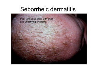Outer Scale In Rash Common Pediatrics Rashes.ppt well explained pictutes | PPT