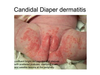 Common Pediatrics Rashes.ppt well explained pictutes | PPT