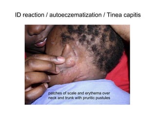 Common Pediatrics Rashes.ppt well explained pictutes | PPT