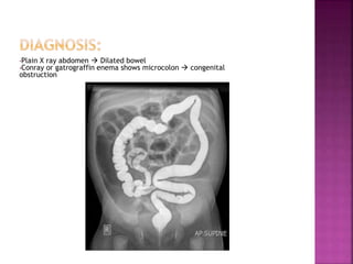 •Plain X ray abdomen  Dilated bowel
•Conray or gatrograffin enema shows microcolon  congenital
obstruction
 