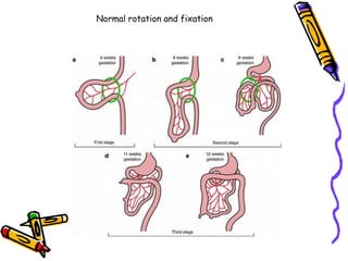 Normal rotation and fixation
 
