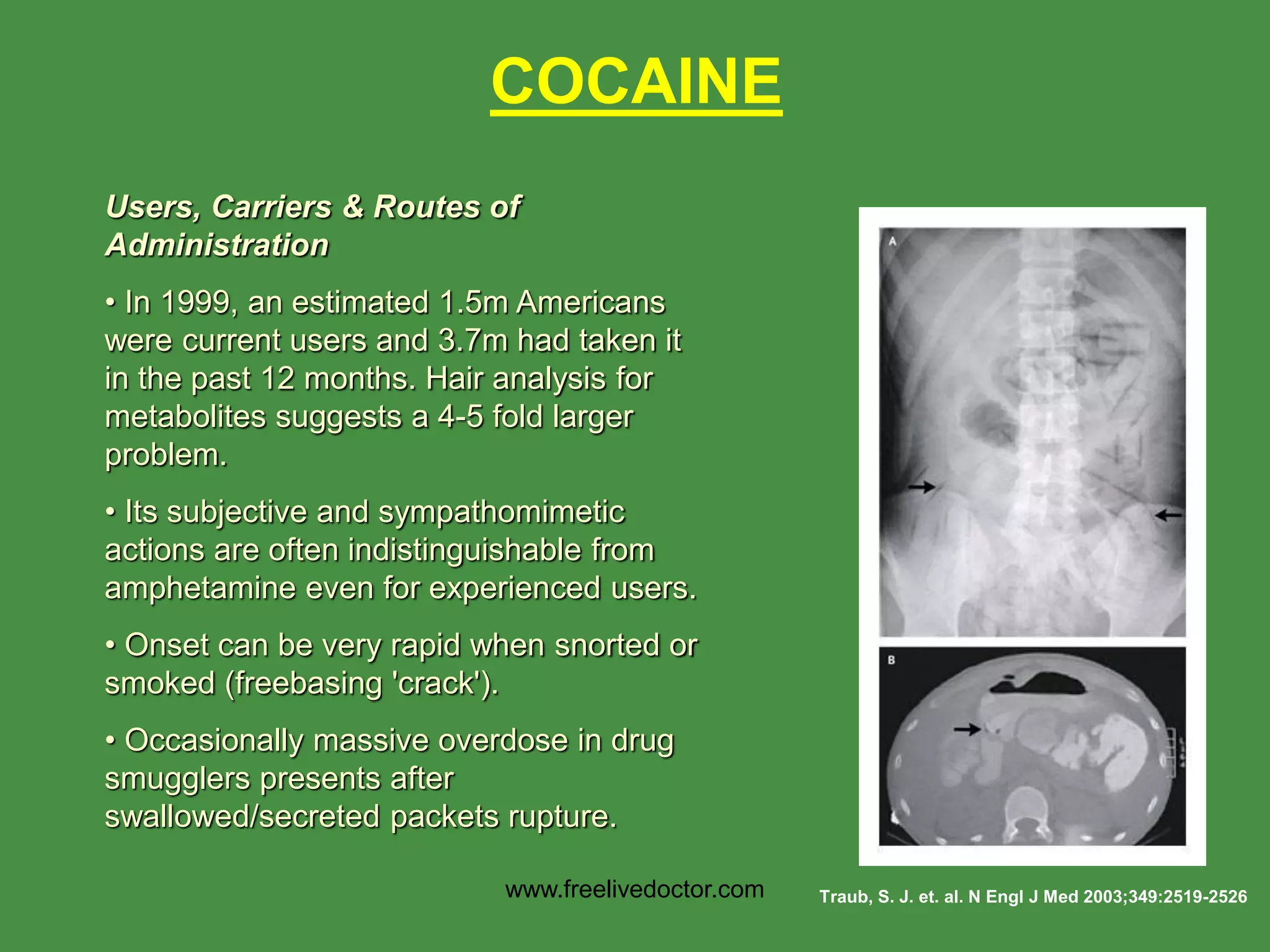 Traub, S. J. et. al. N Engl J Med 2003;349:2519-2526
COCAINE
Users, Carriers & Routes of
Administration
• In 1999, an estimated 1.5m Americans
were current users and 3.7m had taken it
in the past 12 months. Hair analysis for
metabolites suggests a 4-5 fold larger
problem.
• Its subjective and sympathomimetic
actions are often indistinguishable from
amphetamine even for experienced users.
• Onset can be very rapid when snorted or
smoked (freebasing 'crack').
• Occasionally massive overdose in drug
smugglers presents after
swallowed/secreted packets rupture.
www.freelivedoctor.com
 