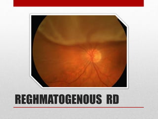 Traction Rd Fundus Common retinal disease | PPTX