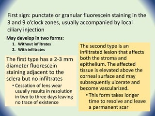 May develop in two forms:
1. Without infiltrates
2. With infiltrates
The first type has a 2-3 mm
diameter fluorescein
staining adjacent to the
sclera but no infiltrates
• Cessation of lens wear
usually results in resolution
in two to three days leaving
no trace of existence
The second type is an
infiltrated lesion that affects
both the stroma and
epithelium. The affected
tissue is elevated above the
corneal surface and may
subsequently ulcerate and
become vascularized.
• This form takes longer
time to resolve and leave
a permanent scar
First sign: punctate or granular fluorescein staining in the
3 and 9 o’clock zones, usually accompanied by local
ciliary injection
 