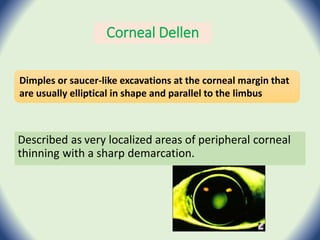 Corneal Dellen
Described as very localized areas of peripheral corneal
thinning with a sharp demarcation.
Dimples or saucer-like excavations at the corneal margin that
are usually elliptical in shape and parallel to the limbus
 