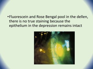 •Fluorescein and Rose Bengal pool in the dellen,
there is no true staining because the
epithelium in the depression remains intact
 