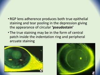•RGP lens adherence produces both true epithelial
staining and tear pooling in the depression giving
the appearance of circular ‘pseudostain’
•The true staining may be in the form of central
patch inside the indentation ring and peripheral
arcuate staining
 