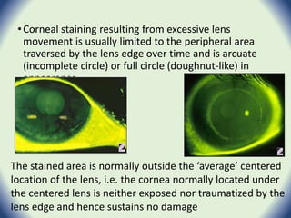 •Corneal staining resulting from excessive lens
movement is usually limited to the peripheral area
traversed by the lens edge over time and is arcuate
(incomplete circle) or full circle (doughnut-like) in
appearance
The stained area is normally outside the ‘average’ centered
location of the lens, i.e. the cornea normally located under
the centered lens is neither exposed nor traumatized by the
lens edge and hence sustains no damage
 