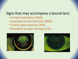 Signs that may accompany a bound lens:
•Corneal indentation (96%)
•Localized corneal distortion (88%)
•Central patch staining (76%)
•Peripheral arcuate staining (17%)
 