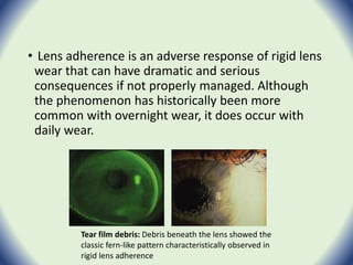 • Lens adherence is an adverse response of rigid lens
wear that can have dramatic and serious
consequences if not properly managed. Although
the phenomenon has historically been more
common with overnight wear, it does occur with
daily wear.
Tear film debris: Debris beneath the lens showed the
classic fern-like pattern characteristically observed in
rigid lens adherence
 