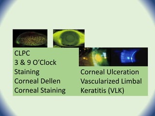 CLPC
3 & 9 O’Clock
Staining
Corneal Dellen
Corneal Staining
Corneal Ulceration
Vascularized Limbal
Keratitis (VLK)
 