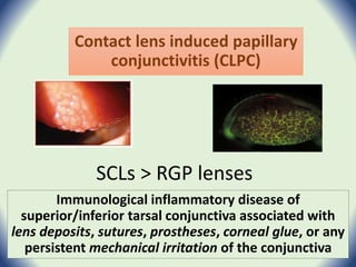 Contact lens induced papillary
conjunctivitis (CLPC)
Immunological inflammatory disease of
superior/inferior tarsal conjunctiva associated with
lens deposits, sutures, prostheses, corneal glue, or any
persistent mechanical irritation of the conjunctiva
SCLs > RGP lenses
 