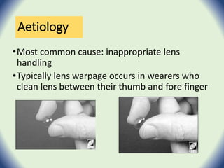 Aetiology
•Most common cause: inappropriate lens
handling
•Typically lens warpage occurs in wearers who
clean lens between their thumb and fore finger
 