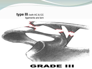 Common shoulder disorders.ppt Common shoulder disorders | PPT