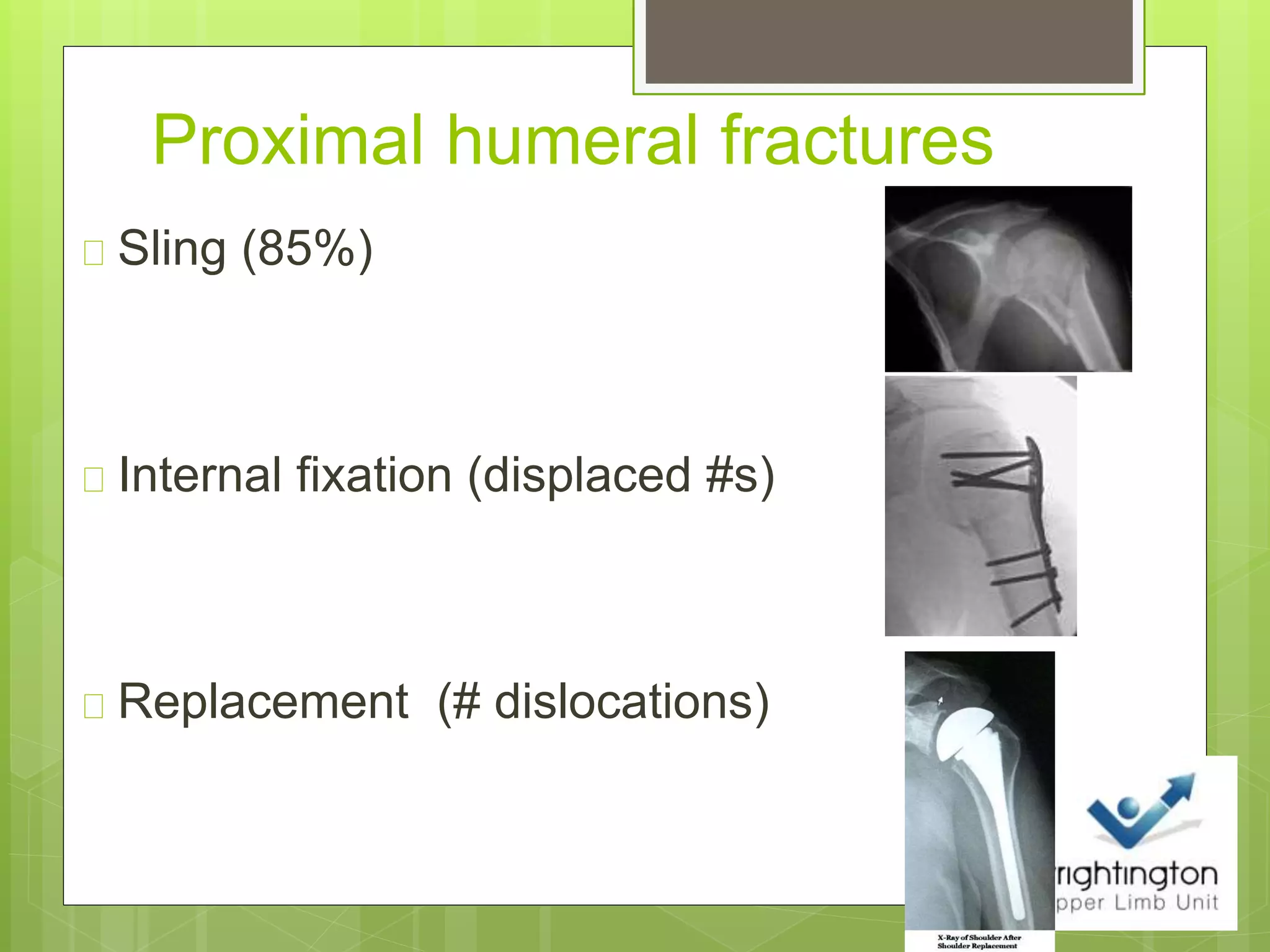 Proximal humeral fractures
Sling (85%)
Internal fixation (displaced #s)
Replacement (# dislocations)
 