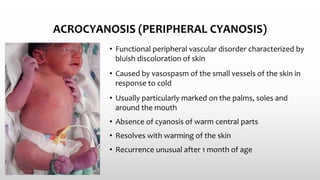 ACROCYANOSIS (PERIPHERAL CYANOSIS)
• Functional peripheral vascular disorder characterized by
bluish discoloration of skin
• Caused by vasospasm of the small vessels of the skin in
response to cold
• Usually particularly marked on the palms, soles and
around the mouth
• Absence of cyanosis of warm central parts
• Resolves with warming of the skin
• Recurrence unusual after 1 month of age
 