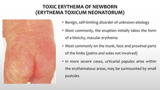 TOXIC ERYTHEMA OF NEWBORN
(ERYTHEMA TOXICUM NEONATORUM)
• Benign, self-limiting disorder of unknown etiology
• Most commonly, the eruption initially takes the form
of a blotchy, macular erythema
• Most commonly on the trunk, face and proximal parts
of the limbs (palms and soles not involved)
• In more severe cases, urticarial papules arise within
the erythematous areas, may be surmounted by small
pustules
 