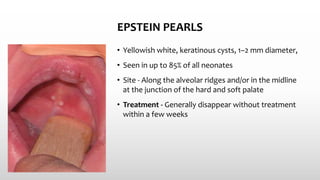 EPSTEIN PEARLS
• Yellowish white, keratinous cysts, 1–2 mm diameter,
• Seen in up to 85% of all neonates
• Site - Along the alveolar ridges and/or in the midline
at the junction of the hard and soft palate
• Treatment - Generally disappear without treatment
within a few weeks
 