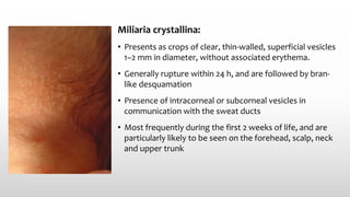 Miliaria crystallina:
• Presents as crops of clear, thin‐walled, superficial vesicles
1–2 mm in diameter, without associated erythema.
• Generally rupture within 24 h, and are followed by bran-
like desquamation
• Presence of intracorneal or subcorneal vesicles in
communication with the sweat ducts
• Most frequently during the first 2 weeks of life, and are
particularly likely to be seen on the forehead, scalp, neck
and upper trunk
 