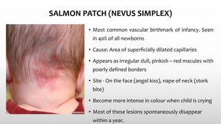 SALMON PATCH (NEVUS SIMPLEX)
• Most common vascular birthmark of infancy. Seen
in 40% of all newborns
• Cause: Area of superﬁcially dilated capillaries
• Appears as irregular dull, pinkish – red macules with
poorly defined borders
• Site - On the face (angel kiss), nape of neck (stork
bite)
• Become more intense in colour when child is crying
• Most of these lesions spontaneously disappear
within a year.
 