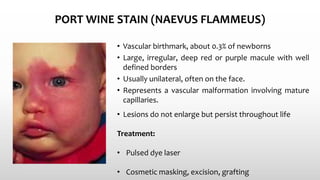 PORT WINE STAIN (NAEVUS FLAMMEUS)
• Vascular birthmark, about 0.3% of newborns
• Large, irregular, deep red or purple macule with well
defined borders
• Usually unilateral, often on the face.
• Represents a vascular malformation involving mature
capillaries.
• Lesions do not enlarge but persist throughout life
Treatment:
• Pulsed dye laser
• Cosmetic masking, excision, grafting
 