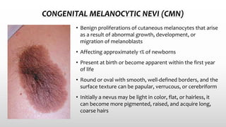 CONGENITAL MELANOCYTIC NEVI (CMN)
• Benign proliferations of cutaneous melanocytes that arise
as a result of abnormal growth, development, or
migration of melanoblasts
• Affecting approximately 1% of newborns
• Present at birth or become apparent within the first year
of life
• Round or oval with smooth, well-defined borders, and the
surface texture can be papular, verrucous, or cerebriform
• Initially a nevus may be light in color, flat, or hairless, it
can become more pigmented, raised, and acquire long,
coarse hairs
 