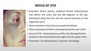 NEVUS OF OTA
• Extensive, bluish, patchy, unilateral dermal melanocytosis
that affects the sclera and the skin adjacent to the eye,
distributed along the first and the second branches of the
trigeminal nerve
• More common in Asians (0.014-0.034%) and blacks
• Most are present at birth or develop during first year of life
• Nevus of ITO – Same features as OTA, only distinguished by
location in the acromioclavicular region and the upper chest.
• Treatment - Q‐switched lasers, Cosmetic camouflage
 