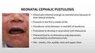 NEONATAL CEPHALIC PUSTULOSIS
• Historically referred wrongly as neonatal acne because of
their clinical similarity
• Presents in the first 3 weeks of life
• Prevalence varies between 10 and 66% of newborns
• Postulated to develop in association with Malassezia
• Characterized by erythematous papulopustules,
surrounded by erythematous halo
• Site - cheeks, chin, eyelids, neck and upper chest
 
