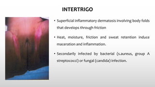 INTERTRIGO
• Superficial inflammatory dermatosis involving body folds
that develops through friction
• Heat, moisture, friction and sweat retention induce
maceration and inflammation.
• Secondarily infected by bacterial (s.aureus, group A
streptococci) or fungal (candida) infection.
 
