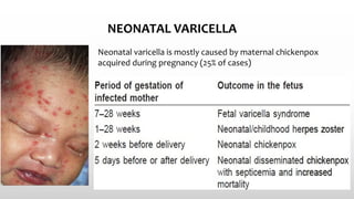 NEONATAL VARICELLA
Neonatal varicella is mostly caused by maternal chickenpox
acquired during pregnancy (25% of cases)
 