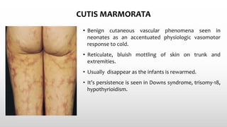 CUTIS MARMORATA
• Benign cutaneous vascular phenomena seen in
neonates as an accentuated physiologic vasomotor
response to cold.
• Reticulate, bluish mottling of skin on trunk and
extremities.
• Usually disappear as the infants is rewarmed.
• It’s persistence is seen in Downs syndrome, trisomy-18,
hypothyrioidism.
 
