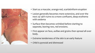 • Start as a macular, orange‐red, scarlatiniform eruption
• Lesion generally becomes more extensive, and over the
next 24–48 h turns to a more confluent, deep erythema
with oedema
• Surface then becomes wrinkled before starting to
separate, leaving raw, red erosions.
• First appear on face, axillae and groins then spread all over
body.
• Extreme tenderness of the skin is an early feature
• Child is pyrexial and distressed
 