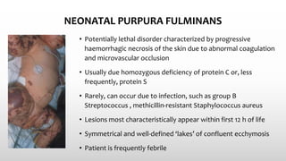 NEONATAL PURPURA FULMINANS
• Potentially lethal disorder characterized by progressive
haemorrhagic necrosis of the skin due to abnormal coagulation
and microvascular occlusion
• Usually due homozygous deficiency of protein C or, less
frequently, protein S
• Rarely, can occur due to infection, such as group B
Streptococcus , methicillin‐resistant Staphylococcus aureus
• Lesions most characteristically appear within first 12 h of life
• Symmetrical and well‐defined ‘lakes’ of confluent ecchymosis
• Patient is frequently febrile
 