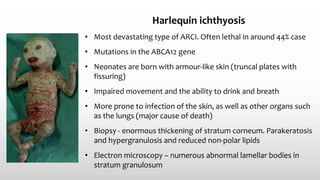 Harlequin ichthyosis
• Most devastating type of ARCI. Often lethal in around 44% case
• Mutations in the ABCA12 gene
• Neonates are born with armour‐like skin (truncal plates with
fissuring)
• Impaired movement and the ability to drink and breath
• More prone to infection of the skin, as well as other organs such
as the lungs (major cause of death)
• Biopsy - enormous thickening of stratum corneum. Parakeratosis
and hypergranulosis and reduced non‐polar lipids
• Electron microscopy – numerous abnormal lamellar bodies in
stratum granulosum
 