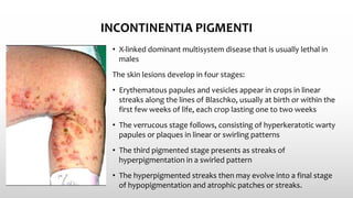 INCONTINENTIA PIGMENTI
• X-linked dominant multisystem disease that is usually lethal in
males
The skin lesions develop in four stages:
• Erythematous papules and vesicles appear in crops in linear
streaks along the lines of Blaschko, usually at birth or within the
first few weeks of life, each crop lasting one to two weeks
• The verrucous stage follows, consisting of hyperkeratotic warty
papules or plaques in linear or swirling patterns
• The third pigmented stage presents as streaks of
hyperpigmentation in a swirled pattern
• The hyperpigmented streaks then may evolve into a final stage
of hypopigmentation and atrophic patches or streaks.
 