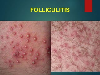 FOLLICULITIS
 
