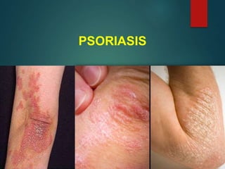 PSORIASIS
 