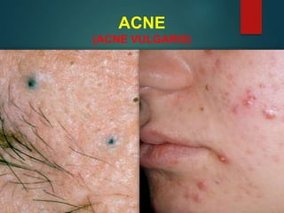 ACNE
(ACNE VULGARIS)
 
