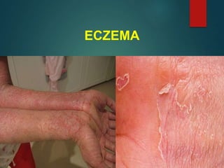 ECZEMA
 