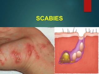 SCABIES
 